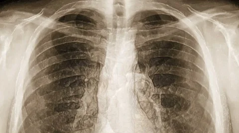 X-ray of chest covered with transparent skin. (loop ready file) Video stock 60641457