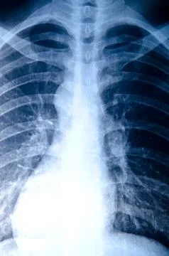 X-ray of chest Stock-Fotos