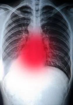 X-ray of chest Stock Photos