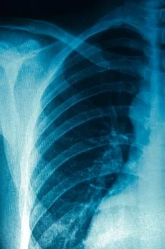X-ray of chest Stock-Fotos