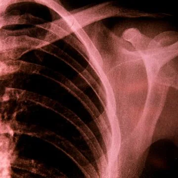 X-ray of chest Foto stock