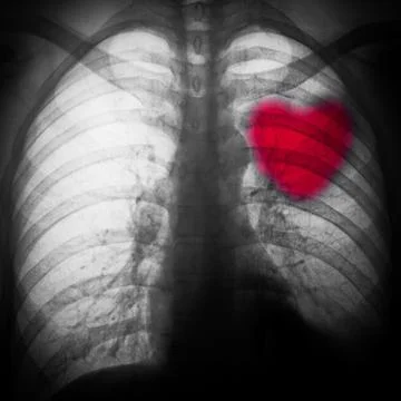 X-ray of chest Stock Photos