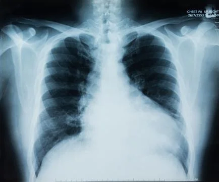 X-ray chest Stock Photos