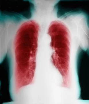 X-ray of chronic obstructive pulmonary disease Stock Photos
