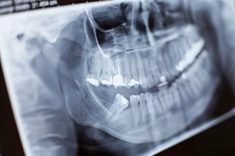 X-ray close-up Stock Photos