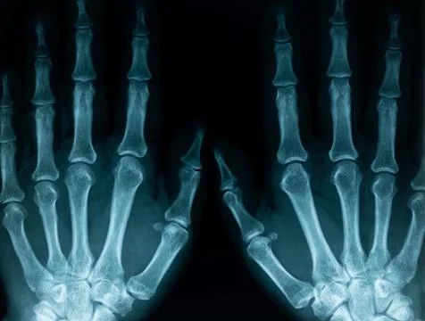 X-ray closeup of hands Stock Photos