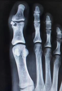 X-ray of a cracked toe 스톡 사진