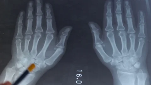 X-ray of damaged joints in hands or MRI 動画素材 77846715