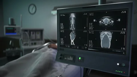 X-ray diagnostic of the chest for damaged organs treatment at the hospital Stock Footage 220472963