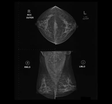 X-ray Digital Mammogram  or mammography  both side of the breast  CC View and Illustrazione stock
