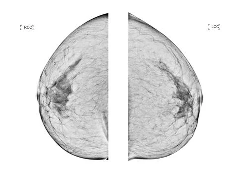 X-ray Digital Mammogram  or mammography  both side of the breast  CC view  fo Stock Illustration