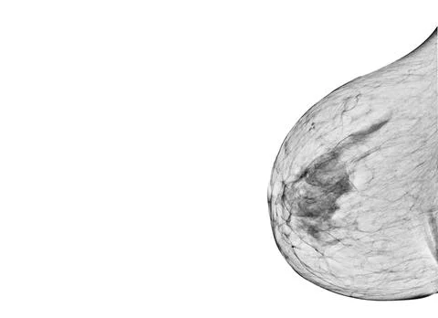 X-ray Digital Mammogram  or mammography  both side of the breast  CC view  fo Stock Illustration
