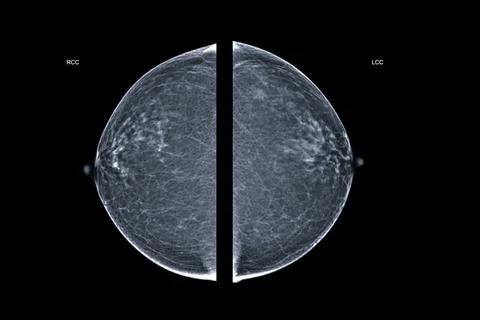 X-ray Digital Mammogram  or mammography  both side of the breast  CC view  fo Stock Illustration