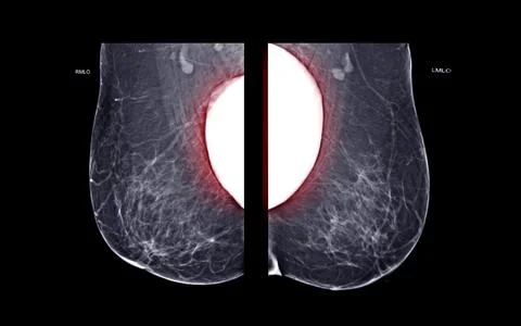 X-ray Digital Mammogram  or mammography  both side of the breast  MLO view  w Stock Illustration