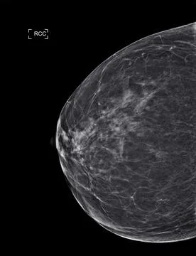 X-ray Digital Mammogram  or mammography  both side of the breast  CC view  fo Stock Illustration