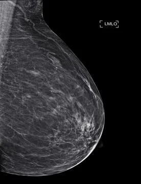 X-ray Digital Mammogram  or mammography at left side of the breast  MLO view  Stock Illustration
