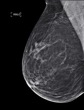 X-ray Digital Mammogram  or mammography at right side of the breast  MLO view Stock Illustration