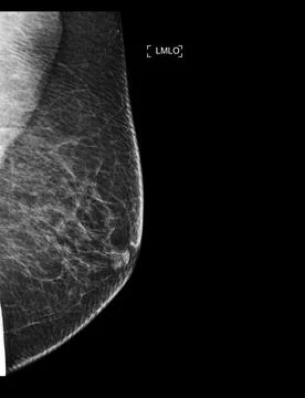 X-ray Digital Mammogram or mammography of both side breast showing benign t.. Stock Illustration