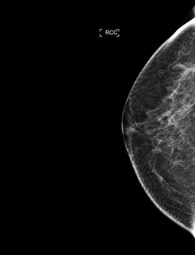 X-ray Digital Mammogram or mammography of both side breast showing benign t.. Stock Illustration