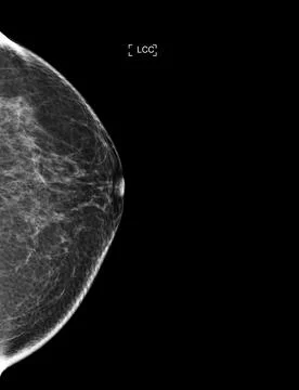 X-ray Digital Mammogram or mammography of both side breast showing benign t.. Stock Illustration