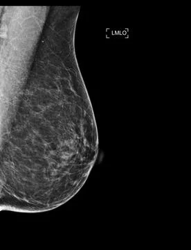 X-ray Digital Mammogram or mammography of both side breast showing Normal b.. Stock Illustration