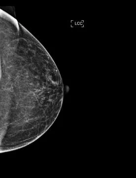X-ray Digital Mammogram or mammography of both side breast showing Normal b.. Stock Illustration
