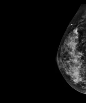 X-ray Digital Mammogram or mammography of both side breast showing benign t.. Stock Illustration