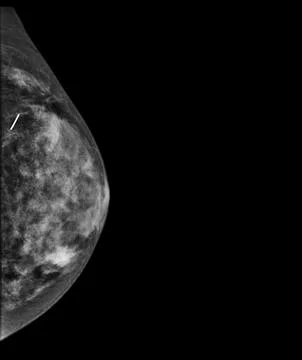 X-ray Digital Mammogram or mammography of both side breast showing benign t.. Illustrazione stock