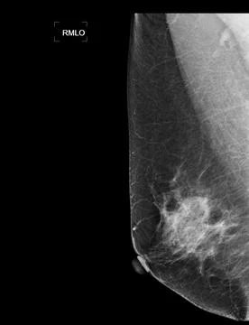 X-ray Digital Mammogram or mammography of both side breast showing benign t.. Stock Illustration