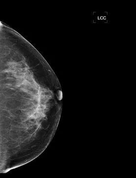 X-ray Digital Mammogram or mammography of both side breast showing benign t.. Stock-Illustration