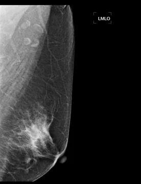 X-ray Digital Mammogram or mammography of both side breast showing benign t.. Stock Illustration