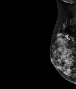 X-ray Digital Mammogram or mammography of both side breast showing benign t.. Stock Illustration