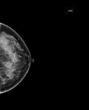 X-ray Digital Mammogram or mammography of both side breast showing benign t.. Stock-Illustration