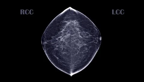 X-ray Digital Mammogram or mammography of both side breast CC View showing .. Illustrazione stock