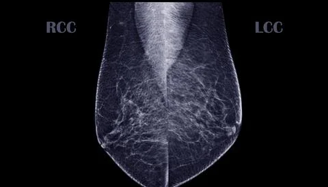 X-ray Digital Mammogram or mammography of both side breast MLO View showing.. Stock-Illustration