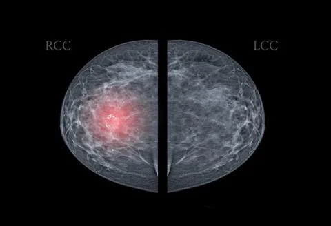 X-ray Digital Mammogram  or mammography  both side of the breast  CC view  fo Stock Photos