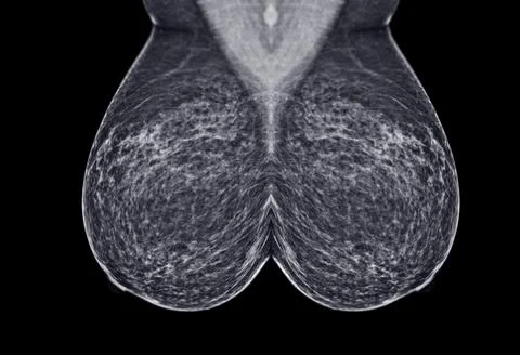X-ray Digital Mammogram  or mammography  of the breast  MLO view. Stock Photos