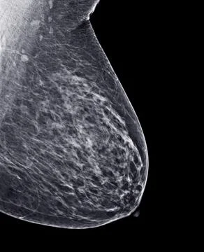 X-ray Digital Mammogram or mammography of both side breast Standard views are Stock Photos
