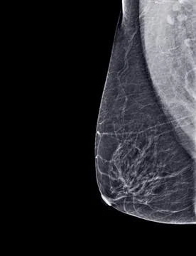 X-ray Digital Mammogram or mammography of both side breast Standard views are Stock Photos