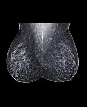 X-ray Digital Mammogram or mammography of both side breast Standard views are Stock Photos