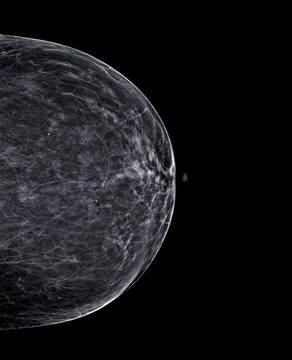 X-ray Digital Mammogram or mammography of both side breast Standard views are Stock Photos