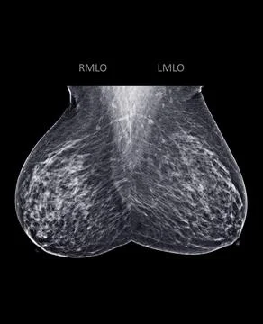 X-ray Digital Mammogram or mammography of both side breast Standard views are Stock Photos