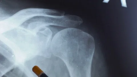 X-ray of the diseased shoulder joint. X-ray of a diseased shoulder joint 動画素材 77846942