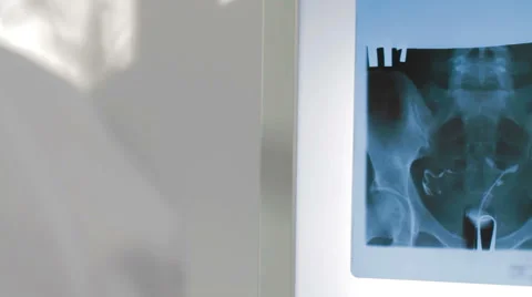 X-ray displayed on an illuminated panel Vídeos de archivo 63576344