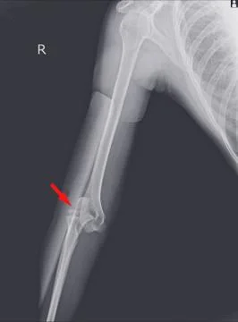 X-ray elbow dislocations and fracture. Stock Photos