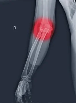 X-ray elbow dislocations and fracture. Stock Photos