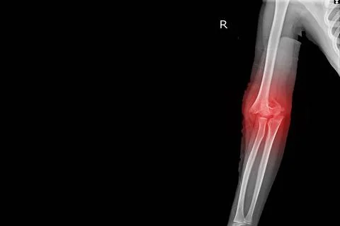 X-ray Elbow joint Finding Supracondylar fracture distal humerus with joint ef Stock Photos