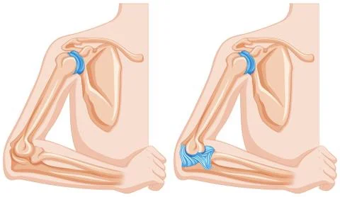 X-ray of elbow joint Stock Illustration