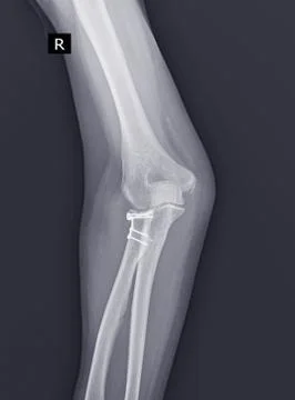 X-ray Elbow joint.After open reduction and internal fixation for radial head  Stock Photos