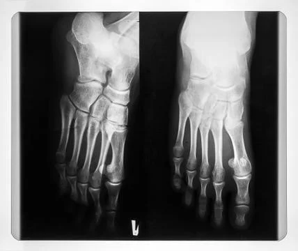 X-ray of the feet Foto stock